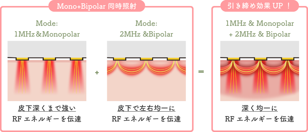 たるみ治療（ダイヤモンドチップ）