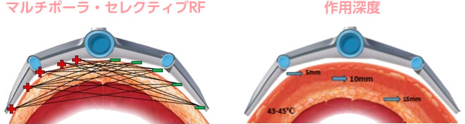 マルチポーラ・セレクティブRF / 作用深度