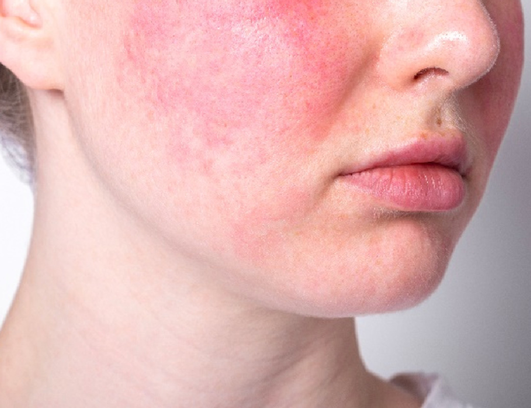 酒さ（しゅさ）